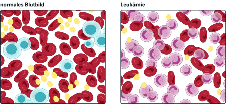 Abb. 2: Im Blutbild links sind hauptsächlich Erythrozyten (kernlose Zellen) und einzelne ausgereifte Leukozyten (hellblau) zu sehen. Im Blutbild rechts, das Leukämie anzeigt, sind Leukämiezellen (violett) und eine reduzierte Zahl an Erythrozyten zu erkennen. Quelle: Blutspende SRK Schweiz (2023)